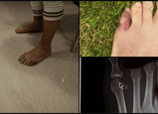 Conor McGregor toe injury